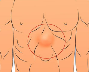 Cirugía de Hernia Epigástrica en Puebla