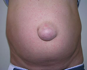 Cirugía de Hernia Umbilical en Puebla